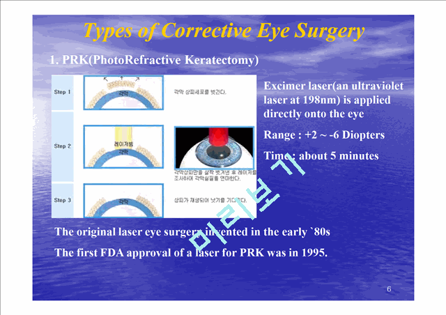 Refrative Laser Eye Surgery.ppt