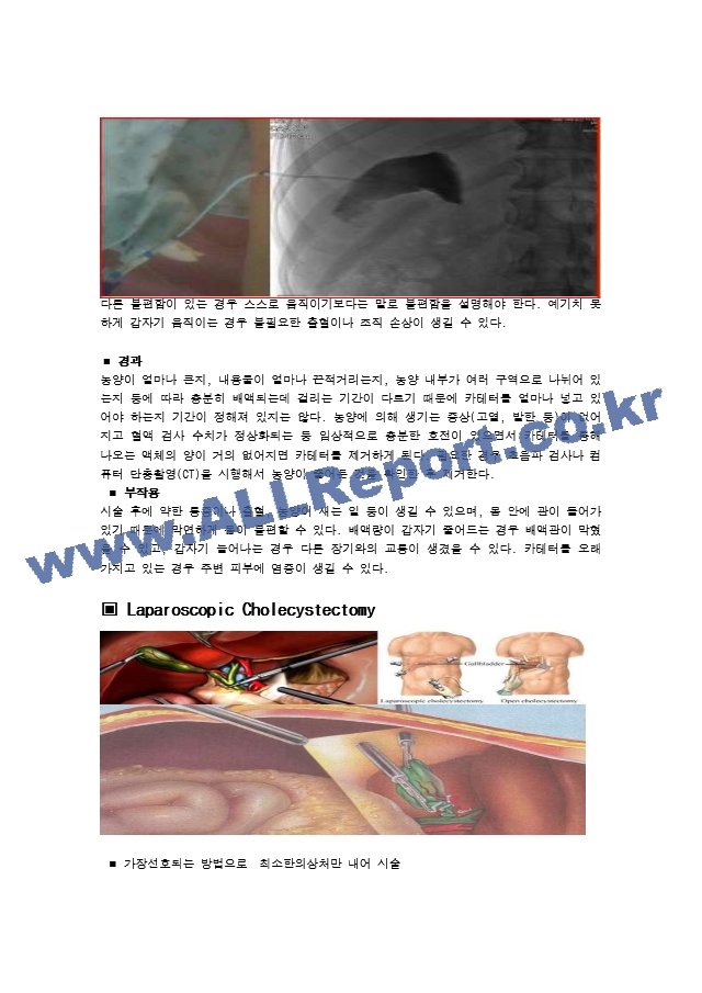 급성 담낭염 문헌고찰.hwp