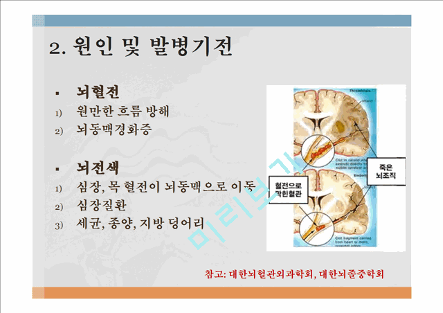 뇌혈관질환 정의 및 현황,뇌혈관질환 원인 및 발병기전,뇌졸중(Stroke), 중풍,고혈압성 뇌출혈,뇌경색,중풍예방,뇌졸증 예방및 처방.pptx