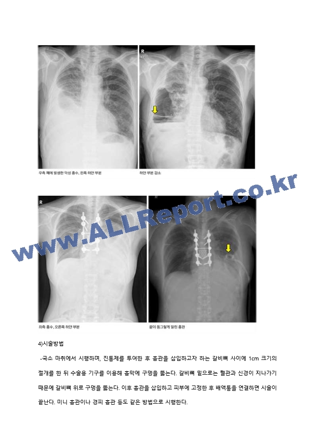 성인케이스-기흉.hwp