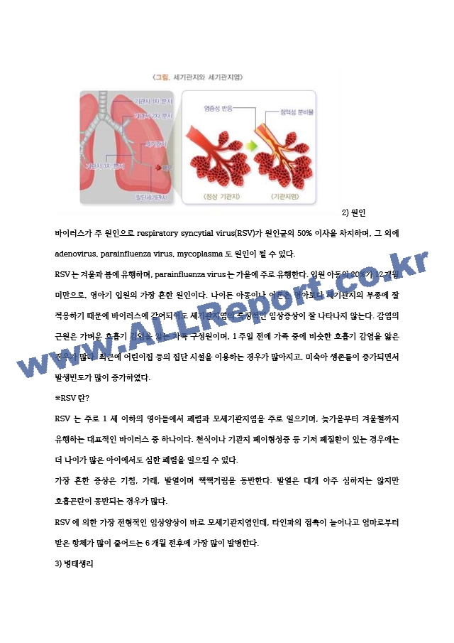 CASE - bronchiolitis.hwp