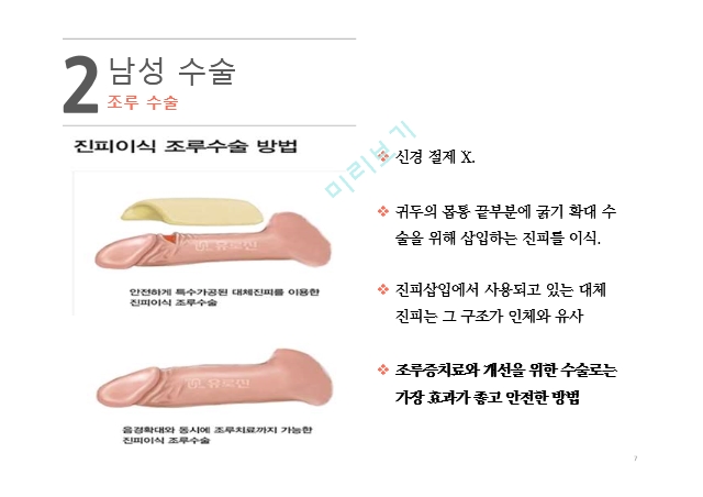 남성 수술,조루증의 원인,조루 수술,확대술 T링,실리콘 구슬 삽입,필러 시술의약보건레포트